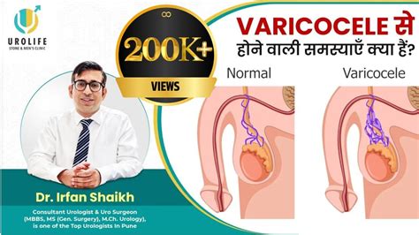 Varicocele से होने वाली समस्याएँ क्या हैं Dr Irfan Shaikh