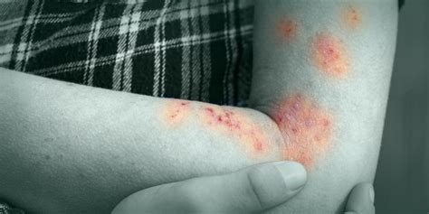 Dermatitis AtÓpica Que Es Causas Y SÍntomas