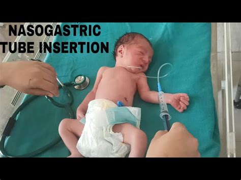 Orogastric Tube Neonate