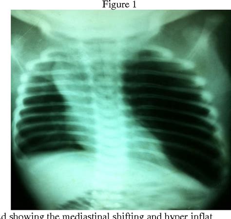 Figure From Congenital Lobar Emphysemma A Rare Case Report