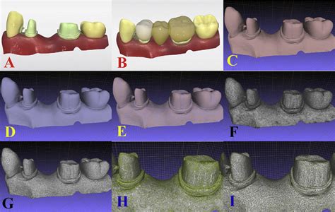 Digital Workflow Of A Cadcam Fixed Dental Prosthesis A Digital