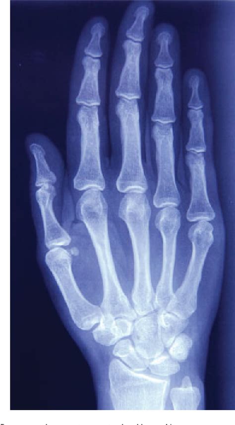 Figure 1 From Extended Pigmented Villonodular Synovitis Of The Hand