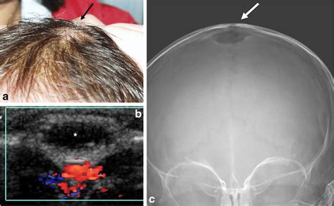 Dermoid Cyst In An 8 Month Old Girl A Clinical Image Shows Soft Tissue