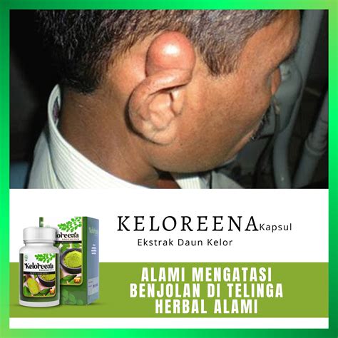 Obat Benjolan Di Telinga Muncul Rasa Gatal Nanah Kemerahan Dan Sakit