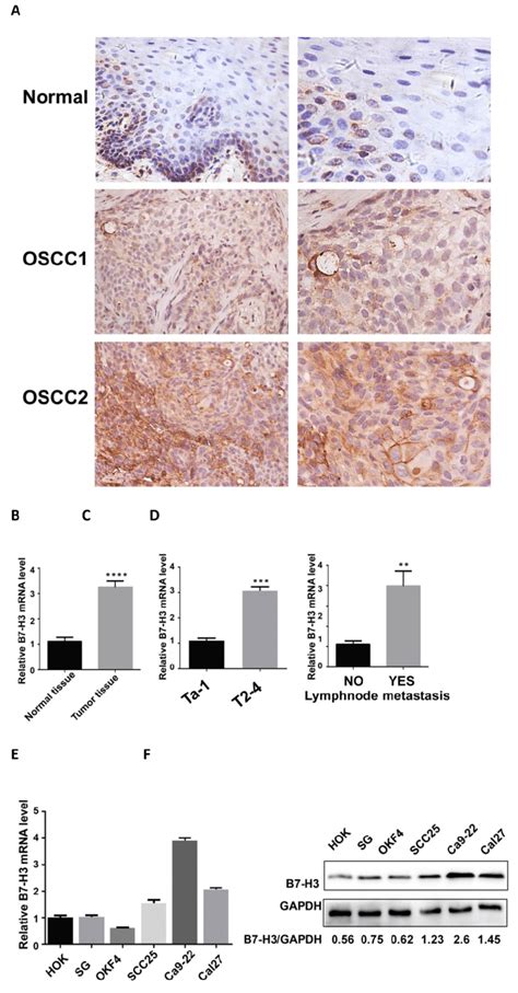 Upregulation Of B H In Oscc Specimens A B H Protein Expression In