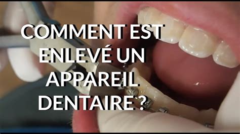 Comment Est Enlevé Un Appareil Dentaire Appareil Youtube