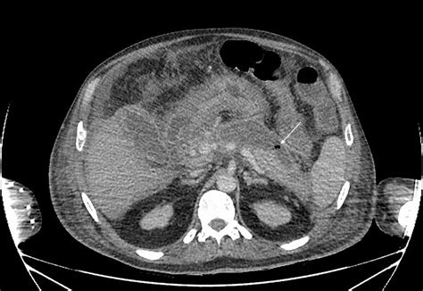 Acute Necrotizing Pancreatitis With Infected Walled Off Necrosis Download Scientific Diagram