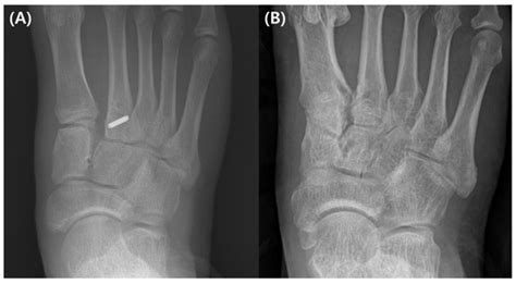 Medicina Free Full Text Various Flexible Fixation Techniques Using Suture Button For