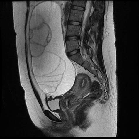 Ovarian Borderline Mucinous Cystadenoma Image