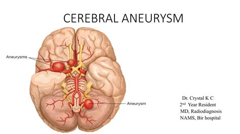 Cerebral Aneurysm Ppt