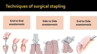 Bowel Anastomosis Ppt