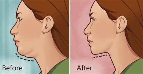 Natural Method To Eliminate Double Chin In A Simple Way Hoy En Belleza