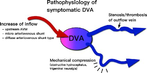 A Diagram Of Symptomatic Developmental Venous Anomalies DVAs The