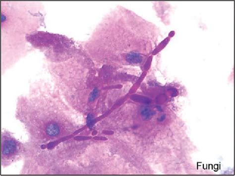 Figure 1 From Microscopic Diagnosis Of Vulvovaginal Candidiasis In