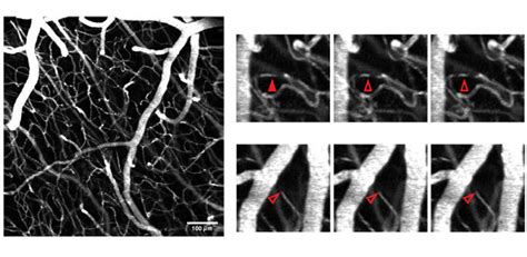 New Method For Detecting Blood Circulation Problems In Brain Capillaries