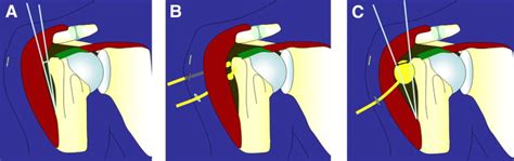 Subacromial Internal Spacer For Rotator Cuff Tendon Repair The