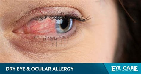 Newark Dry Eye And Ocular Allergy Treatment Center Eye Care Of Delaware