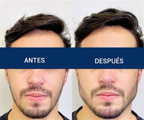 Masculinización Facial Tratamiento con Ácido Hialurónico Clínica