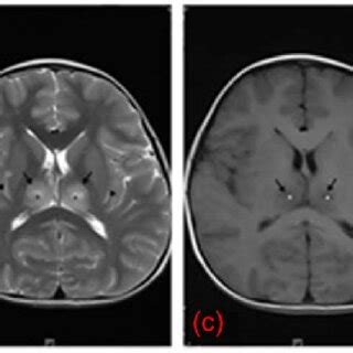 Cranial MRI Of A Patient With IANE From Left To Right A Focal