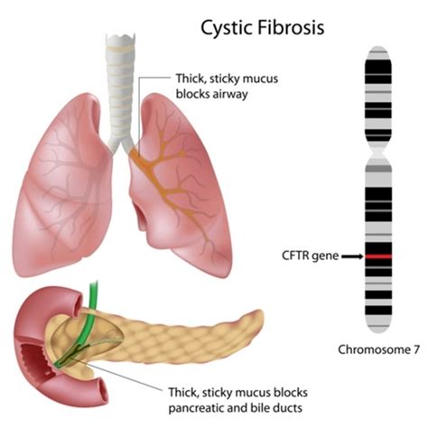 3 900 Cystic Fibrosis Lungs Royalty Free Photos And Stock Images