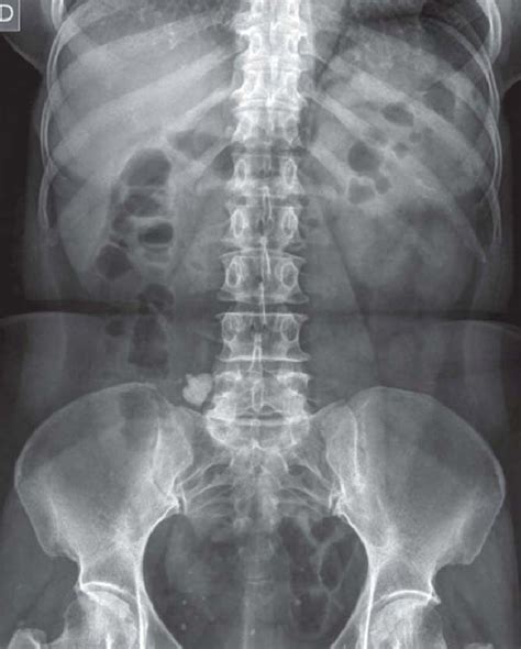 Radiografía simple de abdomen como imagen basal donde se aprecia el... | Download Scientific Diagram