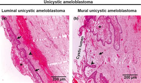 Peripheral Ameloblastoma Histology