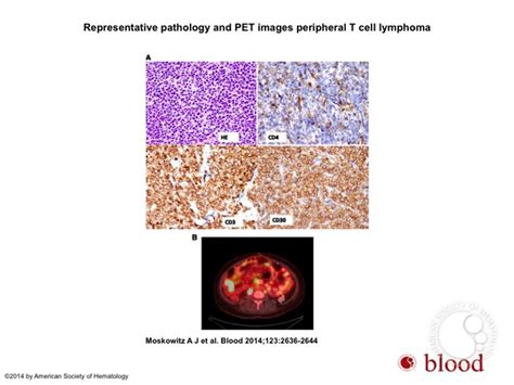 Peripheral T Cell Lymphomas