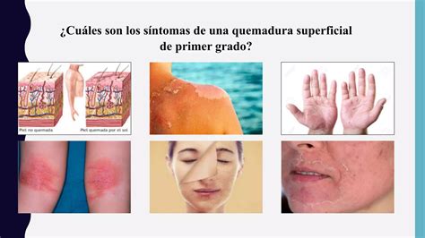 Primeros Auxilios En Quemaduras Ppt
