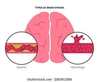 Infarct Images Stock Photos Vectors Shutterstock