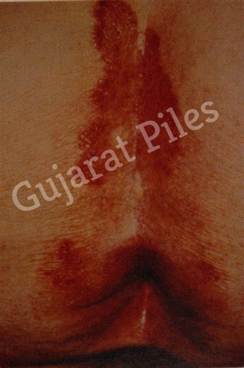 Pruritus Ani Gujarat Piles Gastro Care Center Udaipur