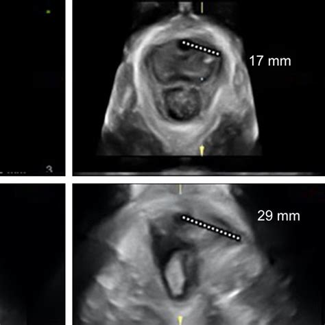 Technique For Transperineal Ultrasound Scan For Fetal Head Descent And