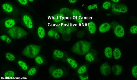 What Types of Cancer Cause Positive ANA - Health Checkup