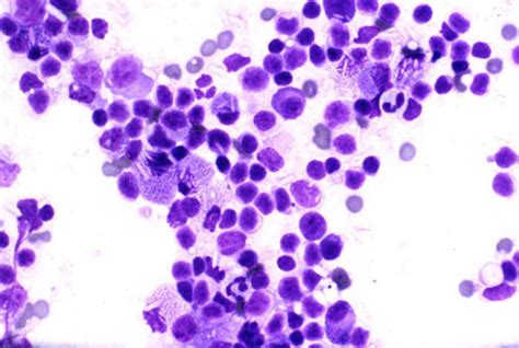 Fine Needle Aspiration Cytology Of The Right Parotid Mass Showing