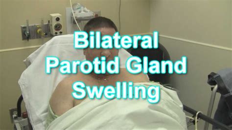 Parotid Gland Swelling