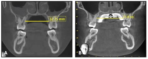 A Tissue And Boneborne Rapid Palatal Expander Jco Online Journal