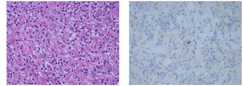 Pathohistological Examination Of The Biopsy Sample A Proliferation