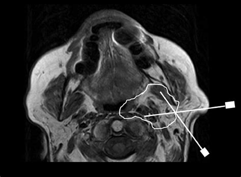 Image Guided Head And Neck Biopsies From Superficial To Deep