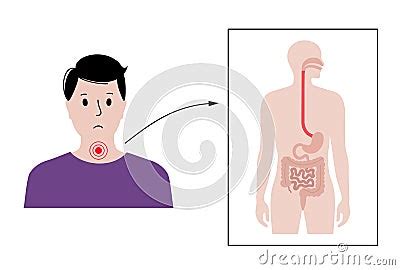 Dysphagia Medical Poster Vector Illustration Cartoondealer