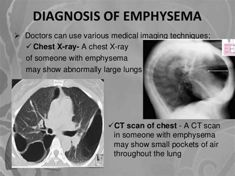 Emphysema