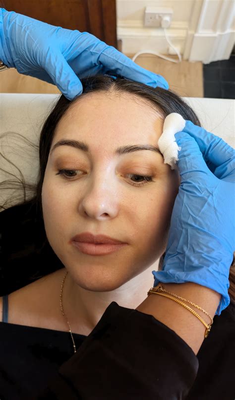 Anal Skin Tag Removal London Harley Street Free Consultation