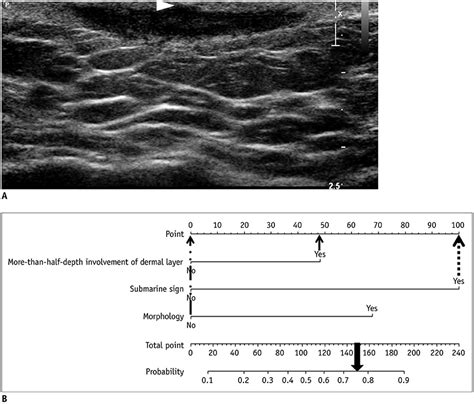 Ultrasound Feature Based Diagnostic Model Focusing On The “submarine