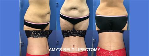 Amy S Belt Lipectomy Amy S Lower Body Lift With Dr Mark Hanikeri