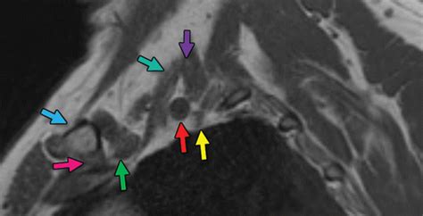 Thoracic Outlet Syndrome Mri Captions Hunter