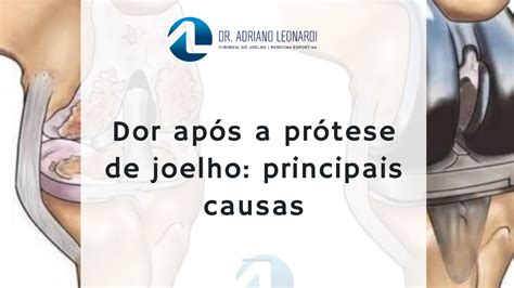 Doença de Osgood Schlatter principal causa de dor no joelho em