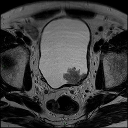 Transitional Cell Carcinoma Urinary Bladder Radiology Reference