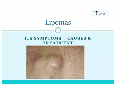 Ppt A Natural Solution For Lipoma Treatment Powerpoint Presentation