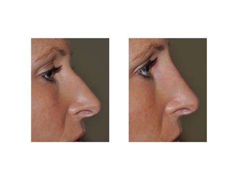 Strategies For Safe Injectable Filler Treatments To The Nose Explore Plastic Surgery