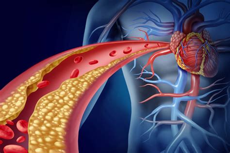 Come Riconoscere Un Infarto Miocardico Sintomi E Terapia