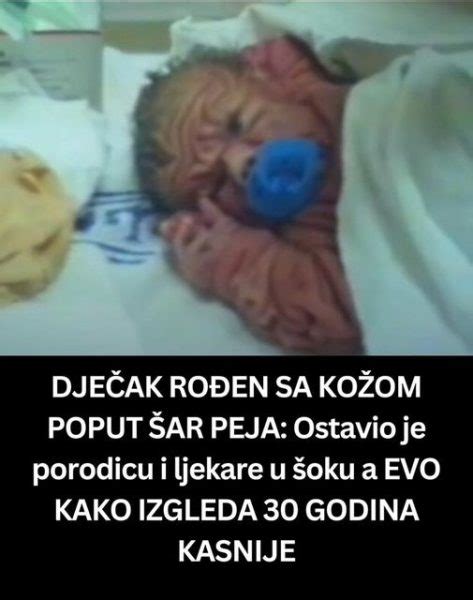 DJEČAK ROĐEN SA KOŽOM POPUT ŠAR PEJA Ostavio je porodicu i ljekare u