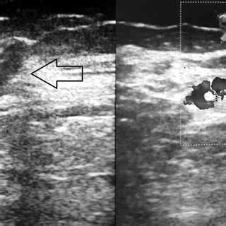 (PDF) Ultrasound-guided perforator vein sealing with cyanoacrylate glue